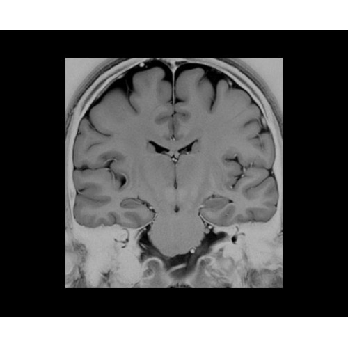 МРТ аппарат GE SIGNA Architect 3.0T