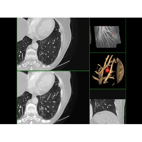 КТ аппарат GE Optima CT520